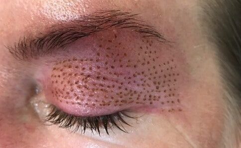 Hoe lang blijven de resultaten van een Plasmage-behandeling zichtbaar?