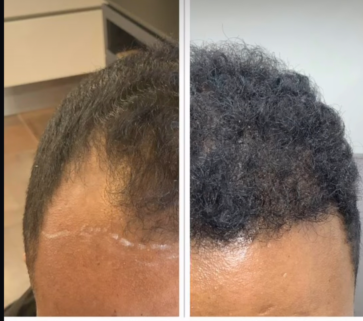 Het probleem van haarverlies en dunner wordend haar