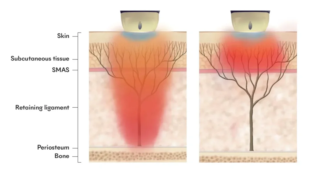 Titanium Lifting Treatment