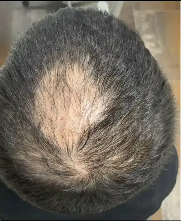 Voor: Haartransplantatie FUE