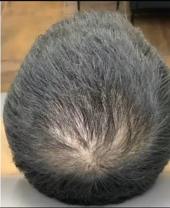 Na: Haartransplantatie FUE