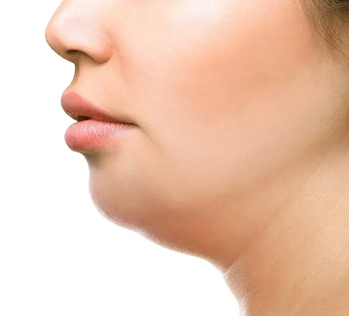 Voor: Kincorrectie behandeling