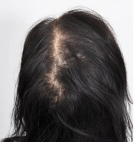 Voor: PRP3 behandeling