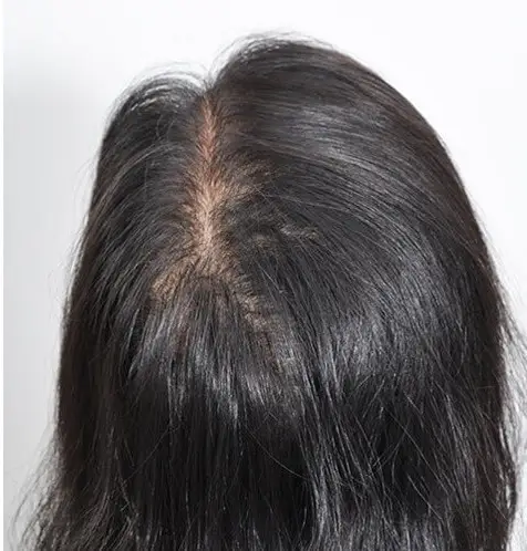 Na: PRP3 behandeling