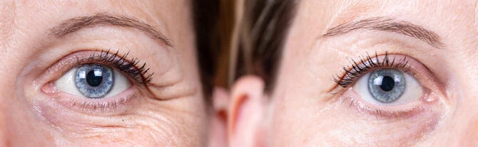 Een Ooglidcorrectie vs een Traangoot filler; dit moet je weten