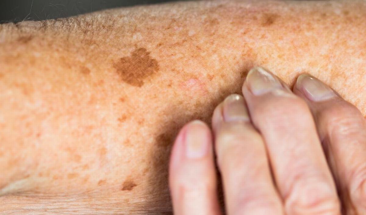 Ouderdomsvlekken verwijderen met Plasmage – Rijkskliniek