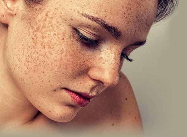 Pigmentvlekken behandelen: Peeling, microneedling en PRP