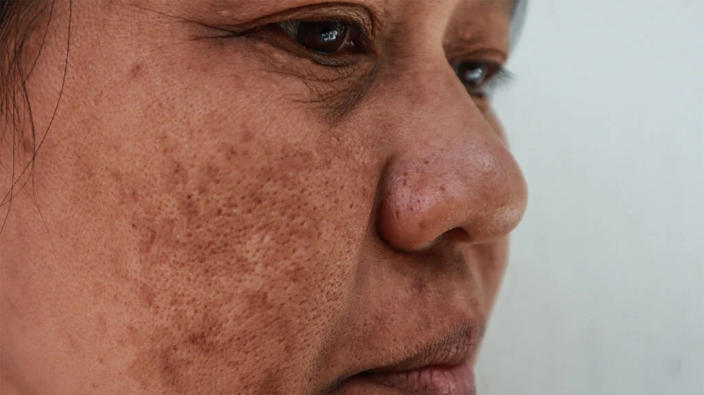 Melasma behandelen? Ontdek de kracht van peeling