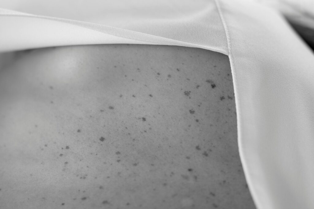 Moedervlekken verwijderen: Electrocoagulatie & Excisie