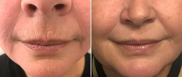 Fijne lijntjes rond de mond behandelen? Ontdek je opties!